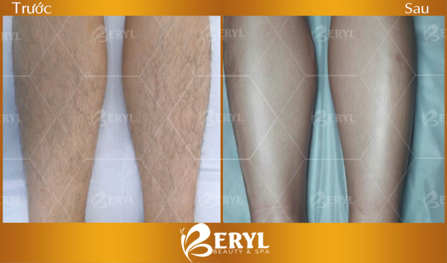 Hình ảnh trước và sau khi triệt lông cho nam giới tại Beryl Beauty & Spa
