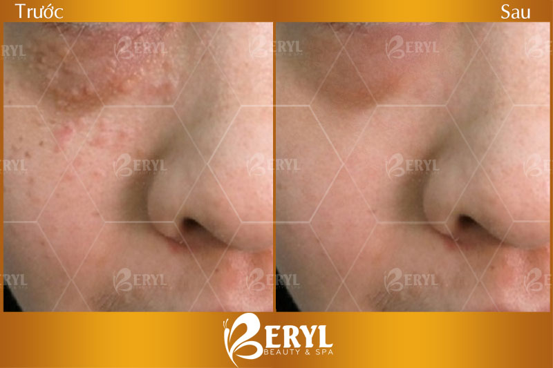 Hình ảnh trước và sau khi điều trị mụn thịt quanh mắt tại Beryl Beauty & Spa TPHCM