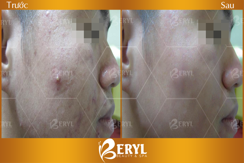 Hình ảnh trước và sau khi trị mụn cho nam tại Beryl Beauty & Spa quận Bình Thạnh TPHCM