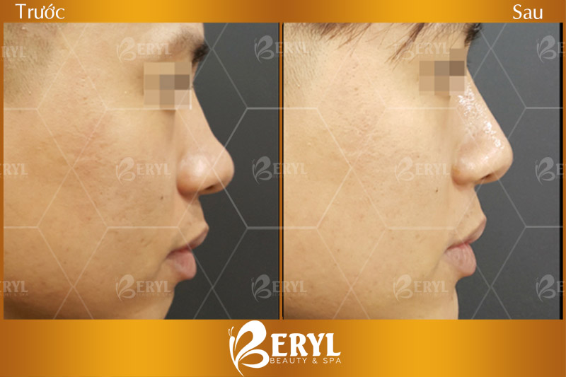 Trước và sau làm trắng da mặt cho nam bằng công nghệ Magic Skin độc quyền tại Beryl Beauty & Spa