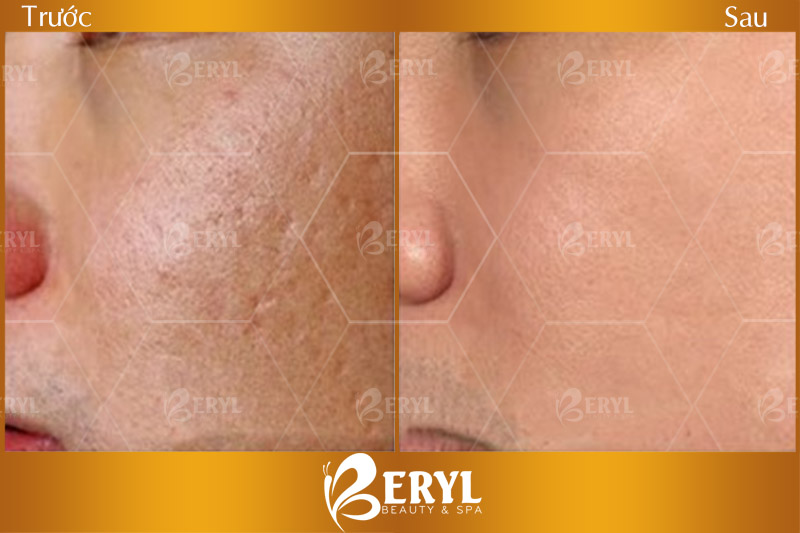 Trước và sau làm trắng da mặt cho nam bằng công nghệ Magic Skin độc quyền tại Beryl Beauty & Spa