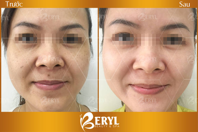 Hình ảnh trước và sau khi trị tàn nhang hiệu quả tại Beryl Beauty & Spa TPHCM