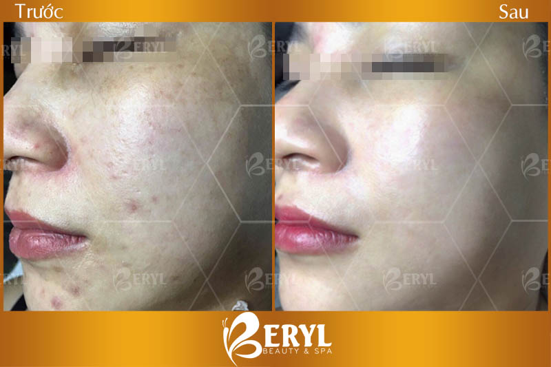 Hình ảnh trước và sau khi trị thâm mụn tại Beryl Beauty TPHCM