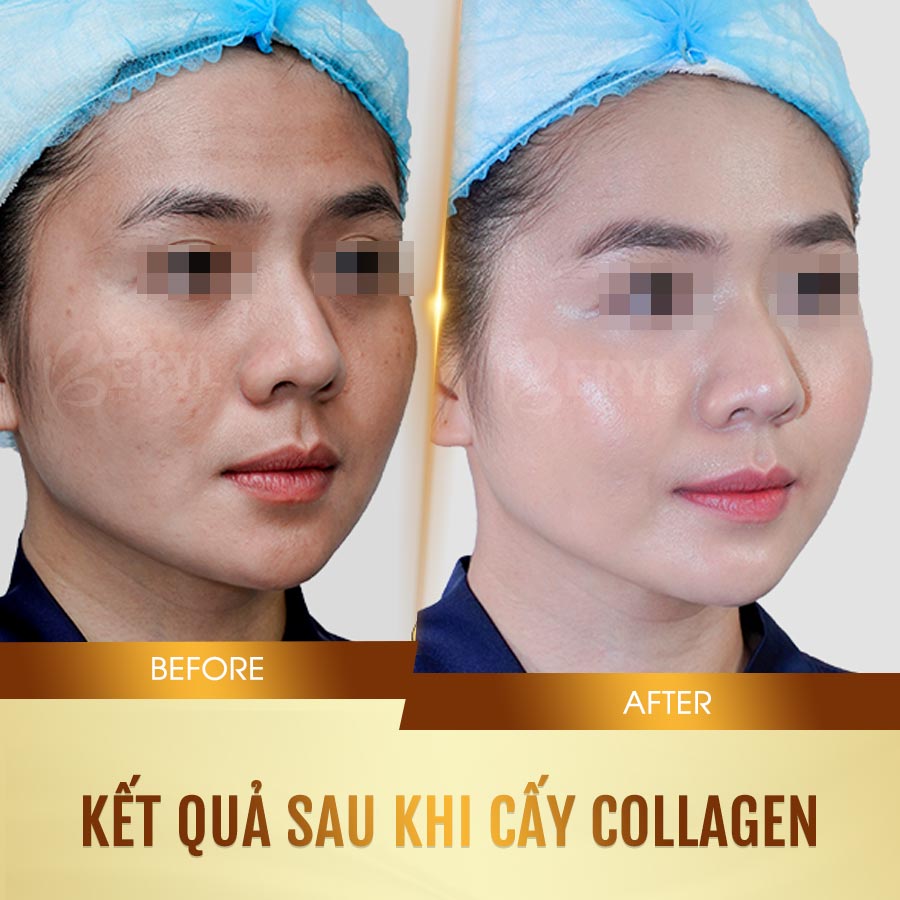 Hình ảnh trước và sau khi cấy collagen tươi căng bóng da mặt tại Beryl Beauty