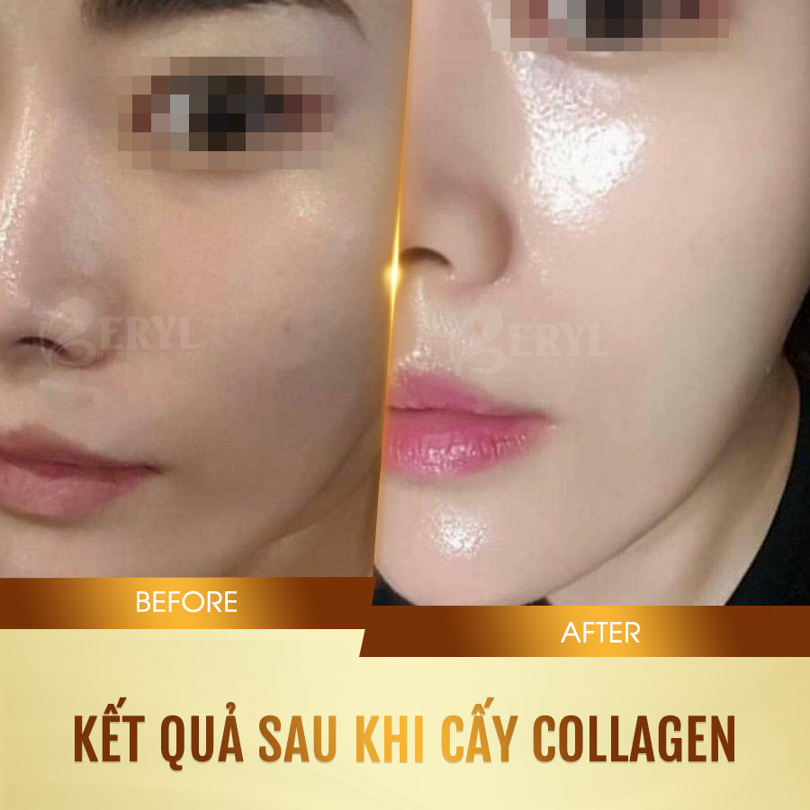 Hình ảnh trước và sau khi cấy collagen tươi căng bóng da mặt tại Beryl Beauty