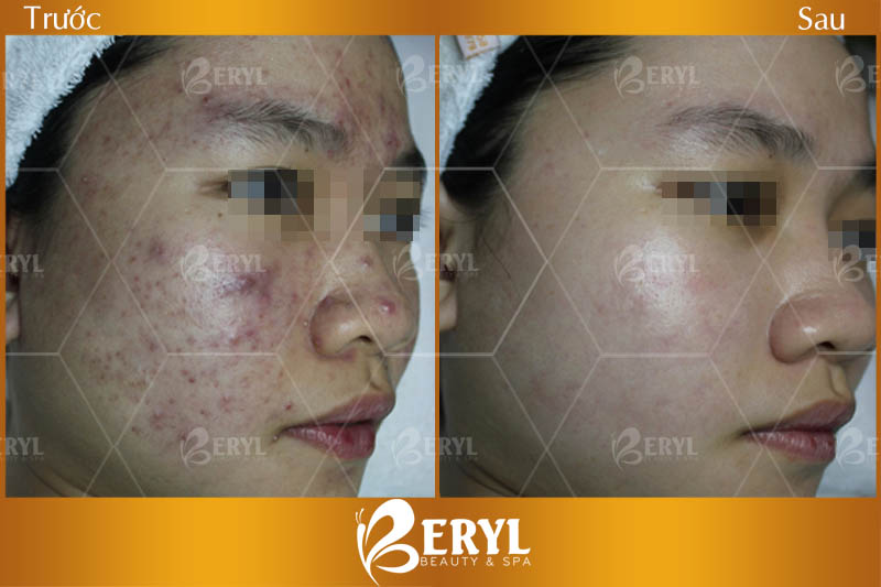 Hình ảnh trước và sau khi trị mụn hiệu quả và uy tín tại Beryl Beauty & Spa