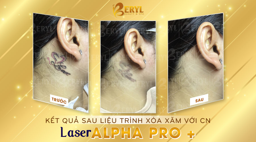 Tham khảo hình trước và sau khi xóa hình xăm bằng laser Alpha Pro+