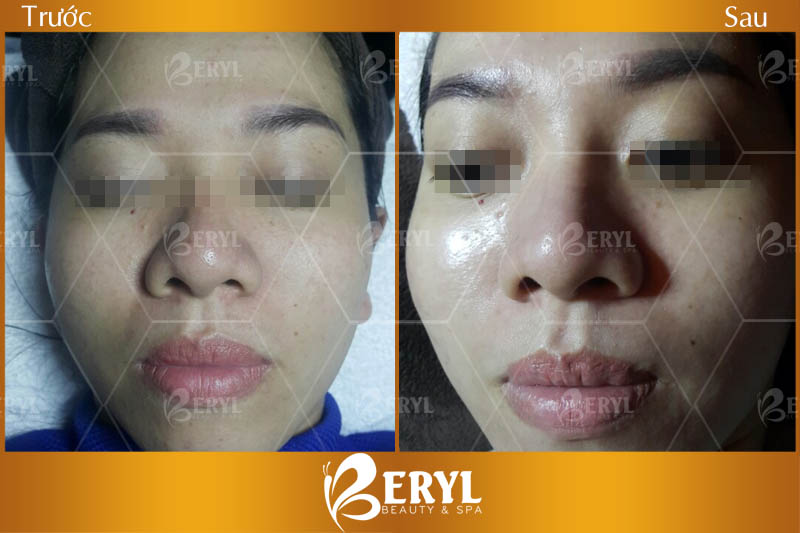 Hình ảnh trước và sau làm trắng da mặt bằng công nghệ Magic Skin tại Beryl Beauty
