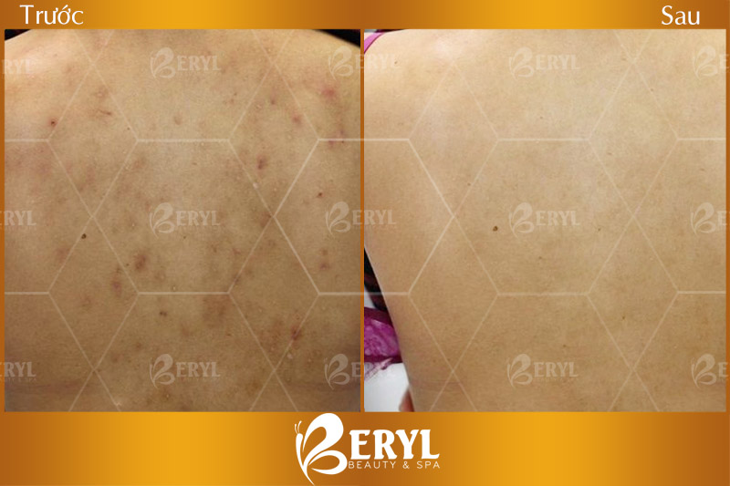 Hình ảnh trước và sau khi điều trị mụn ở lưng bằng công nghệ Blue Light tại Beryl Beauty & Spa