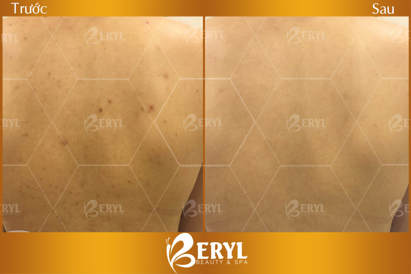Hình ảnh trước và sau khi điều trị mụn ở lưng bằng công nghệ Blue Light tại Beryl Beauty & Spa