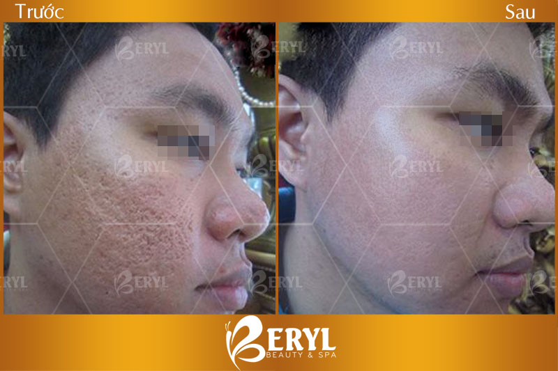 HÌnh ảnh trước và sau khi điều trị sẹo rỗ bằng công nghệ phi kim vi điểm với tế bào gốc tại Beryl Beauty & Spa