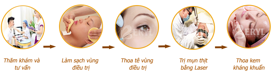 Quy trình điều trị mụn thịt quanh mắt tại Beryl Beauty & Spa