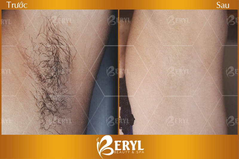 Hình ảnh trước và sau khi triệt lông nách với giá hợp lý tại Beryl Beauty & Spa