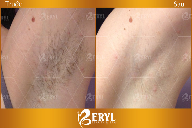 Hình ảnh trước và sau khi triệt lông nách giá hợp lý mà hiệu quả tại Beryl Beauty & Spa