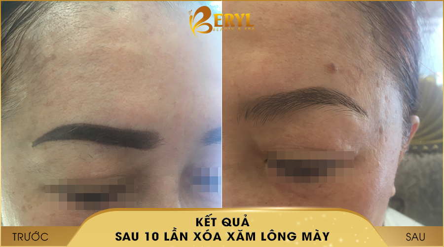 Trước và sau khi xóa xăm lông mày bằng CN Laser Alphatech Pro tại Beryl Beauty & Spa