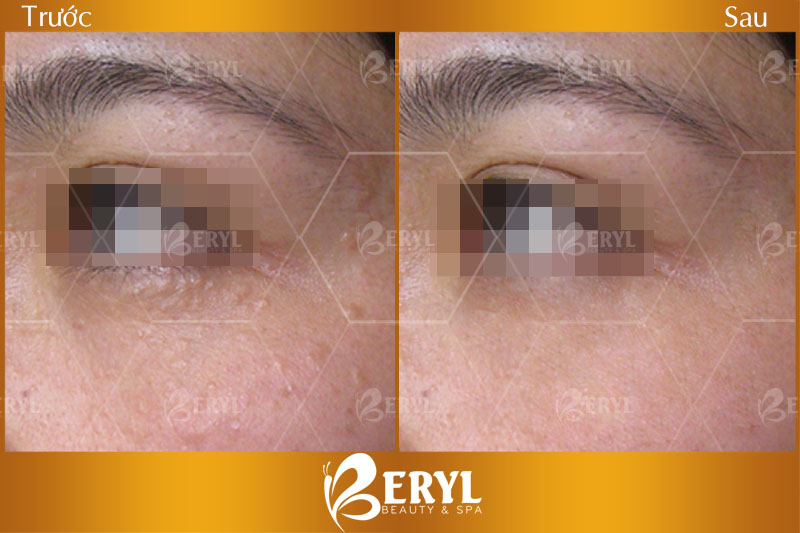 Hình ảnh điều trị mụn thịt quanh mắt an toàn và hiệu quả tại Beryl Beauty & Spa