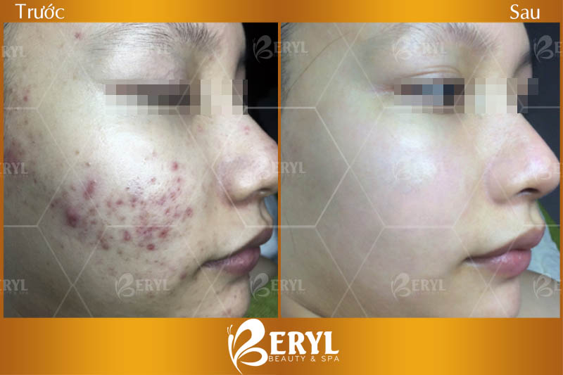 Hình ảnh trước và sau khi điều trị mụn hiệu quả tại Beryl Beauty & Spa