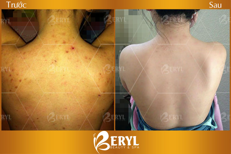 Hình ảnh trước và sau khi điều trị thâm lưng tại Beryl Beauty & Spa