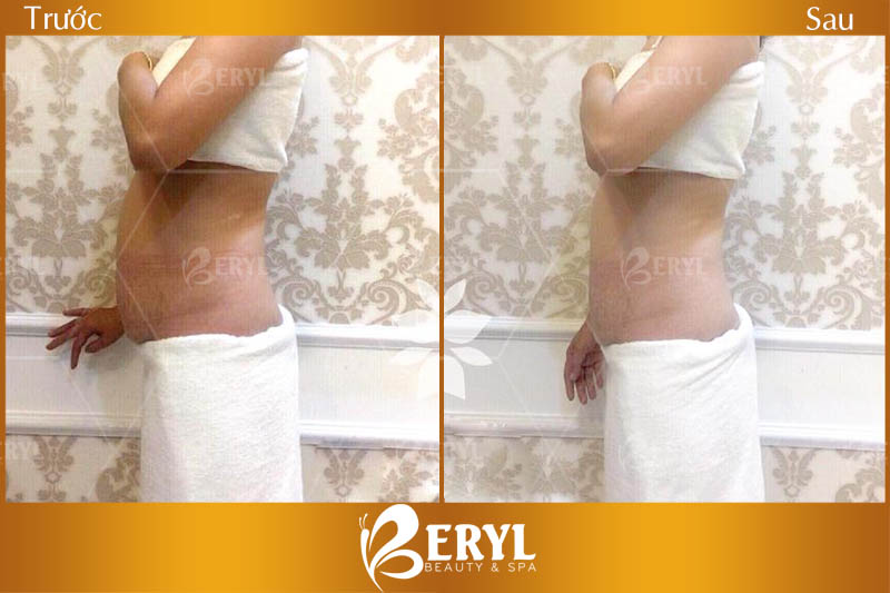 Hình ảnh trước và sau khi giảm béo tại Beryl Beauty & Spa
