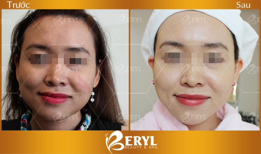 Hình ảnh trước và sau khi nâng cơ mặt, trẻ hóa da tại Beryl Beauty & Spa