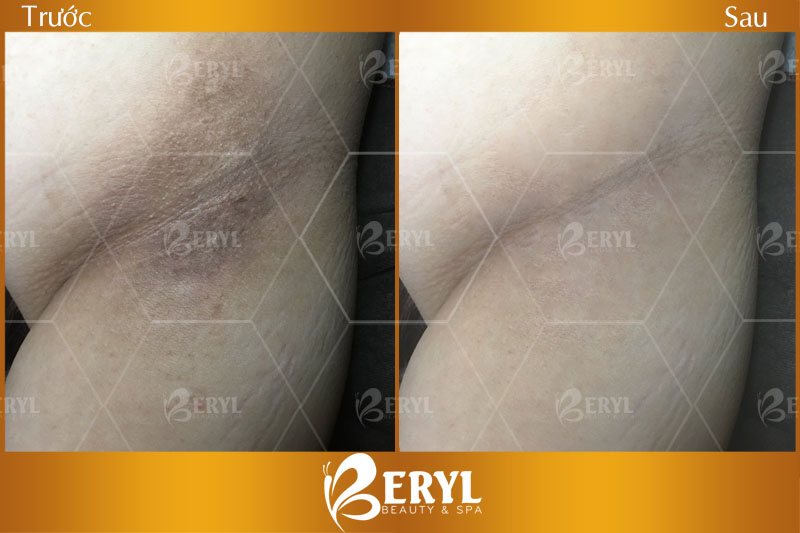 Hình ảnh trước và sau khi trị thâm nách hiệu quả tại Beryl Beauty TPHCM