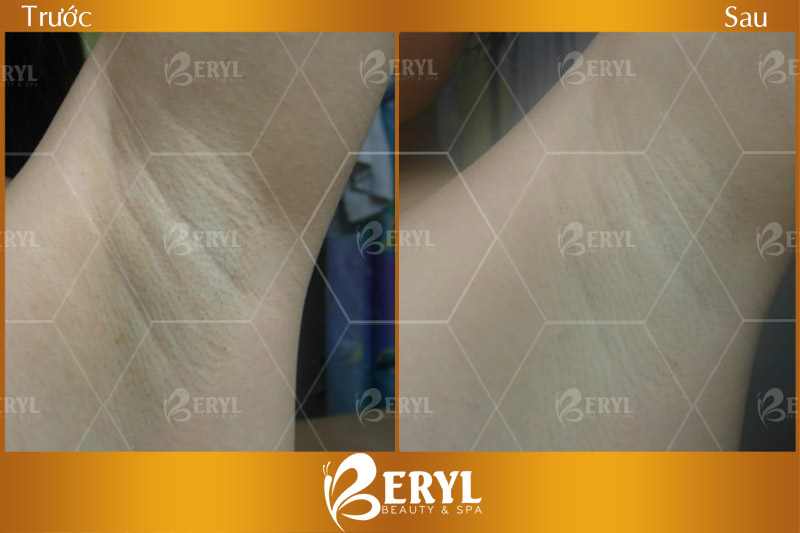 Hình ảnh trước và sau khi trị thâm nách hiệu quả tại Beryl Beauty TPHCM