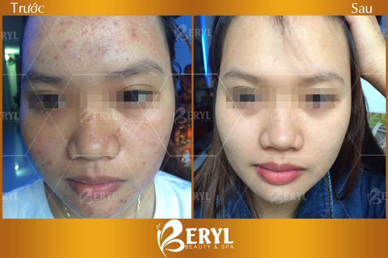 Hình ảnh trước và sau khi trị mụn ở tuổi dậy thì tại Beryl Beauty & Spa