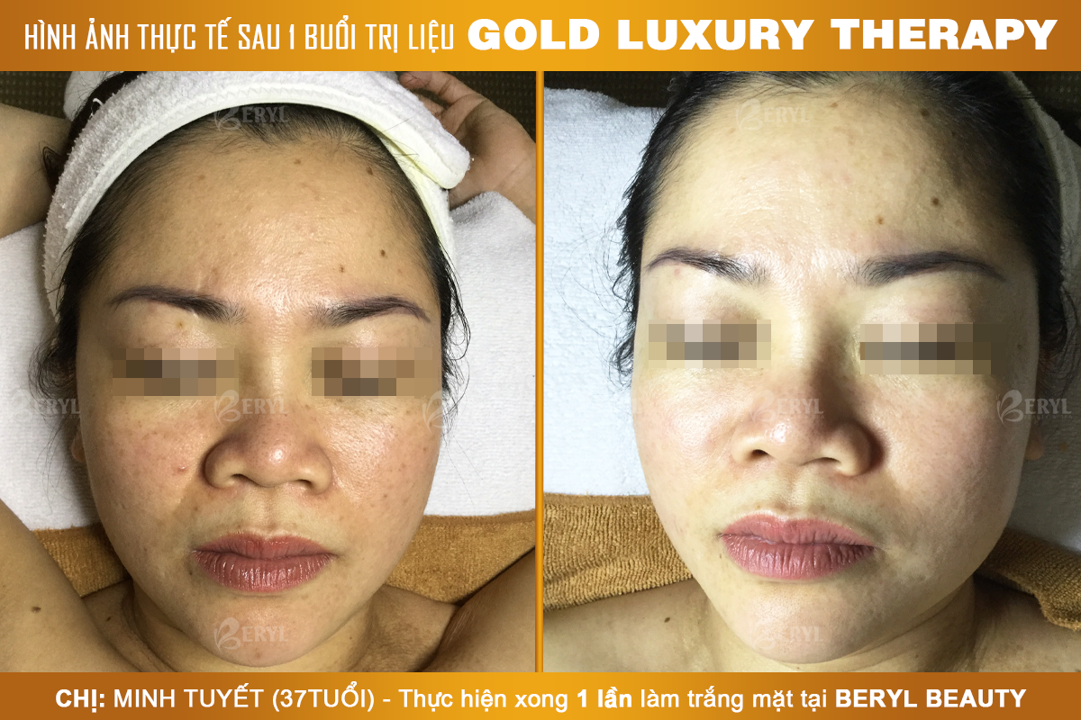 Trước và sau khi làm trắng da mặt Gold Luxury Therapy tại Beryl Beauty & Spa