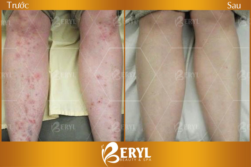 Sau khi điều trị thâm ở chân bằng công nghệ Tảo Silic tại Beryl Beauty & Spa