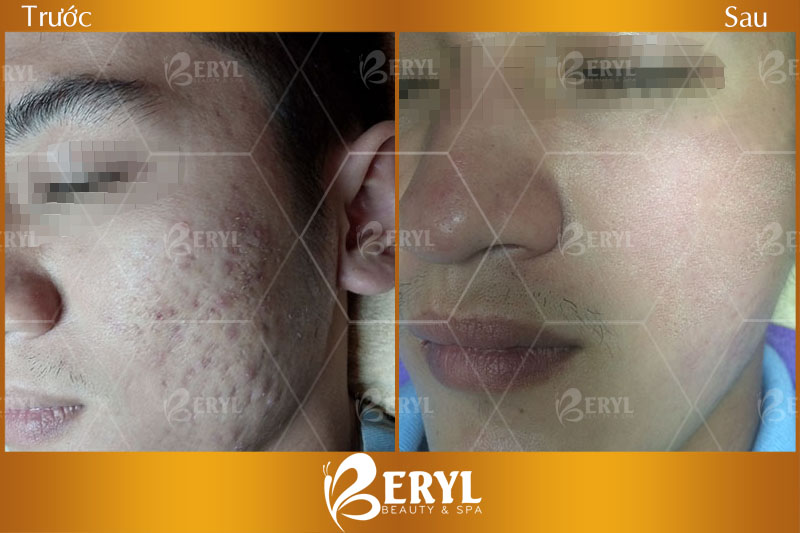 Hình ảnh trước và sau khi làm trắng da mặt cho nam giới ở Beryl Beauty & Spa quận Bình Thạnh