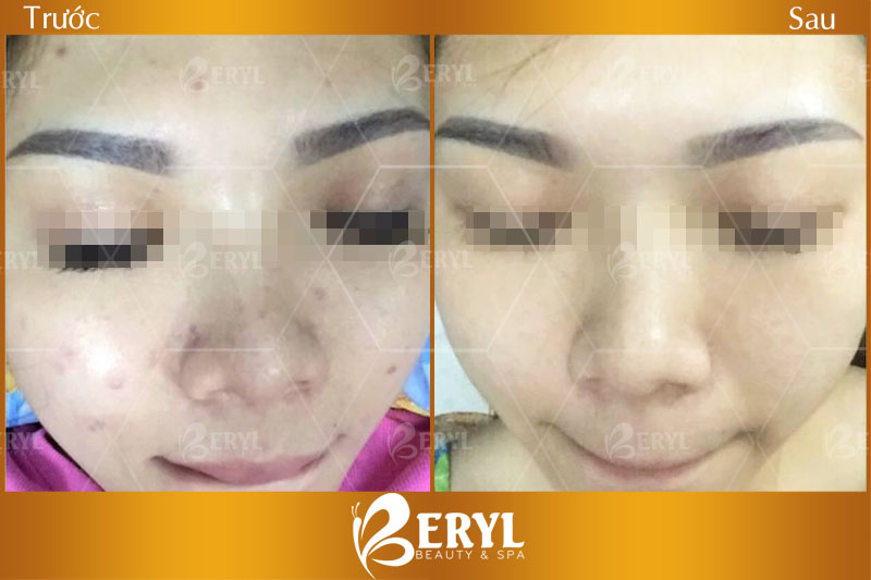 Hình ảnh trước và sau khi trị mụn ẩn dưới da tại Beryl Beauty & Spa quận Bình Thạnh TPHCM
