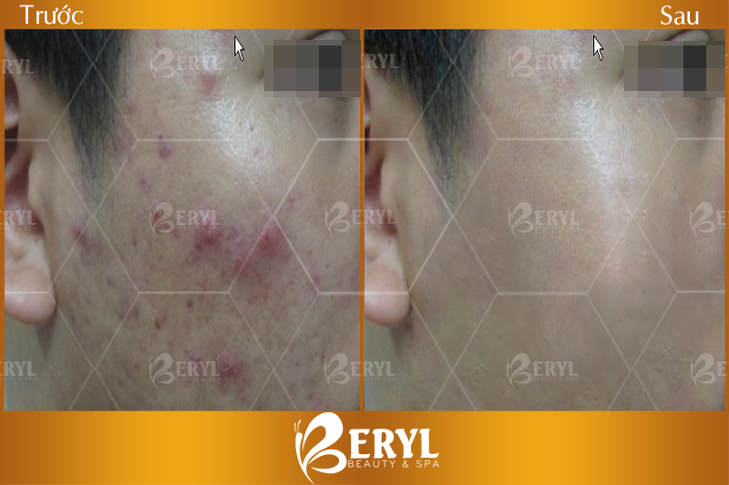 Hình ảnh trước và sau khi trị mụn cho nam tại Beryl Beauty