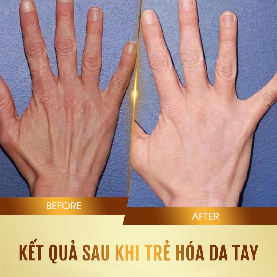 Hình ảnh trước và sau khi chăm sóc dưỡng trẻ hóa da bàn tay của khách hàng tại Beryl Beauty