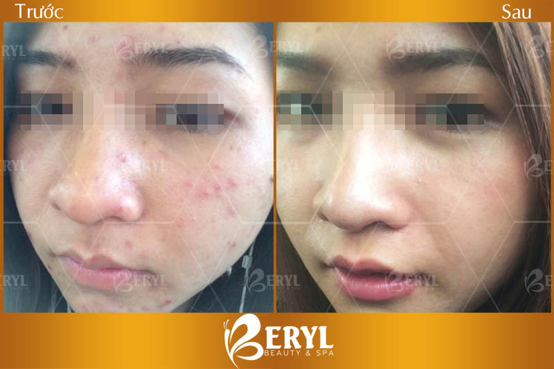 Hình ảnh trước và sau khi trị mụn hiệu quả và uy tín tại Beryl Beauty & Spa TPHCM