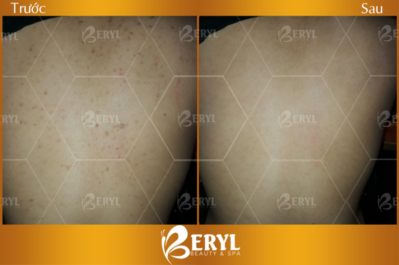 Hình ảnh trước và sau khi điều trị mụn lưng tại Beryl Beauty
