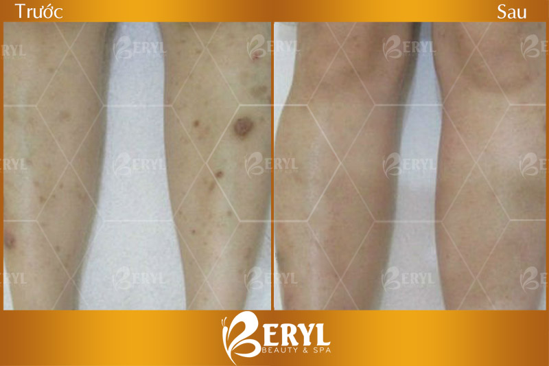 Hình ảnh trước và sau khi trị sẹo thâm ở chân hiệu quả tại Beryl Beauty & Spa TPHCM