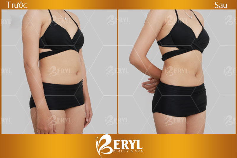 Hình ảnh trước và sau khi giảm béo tại Beryl Beauty & Spa