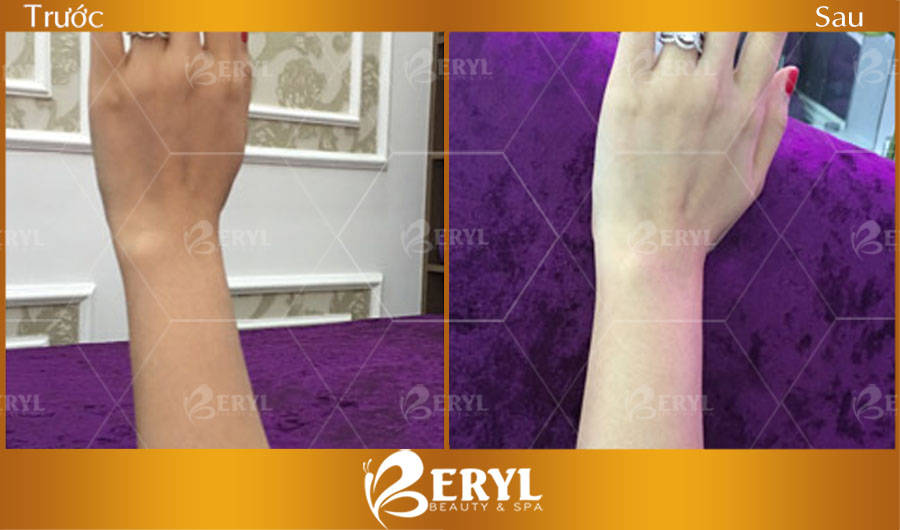 Hình ảnh trước và sau khi thay da sinh học và chăm sóc tại Beryl Beauty & Spa