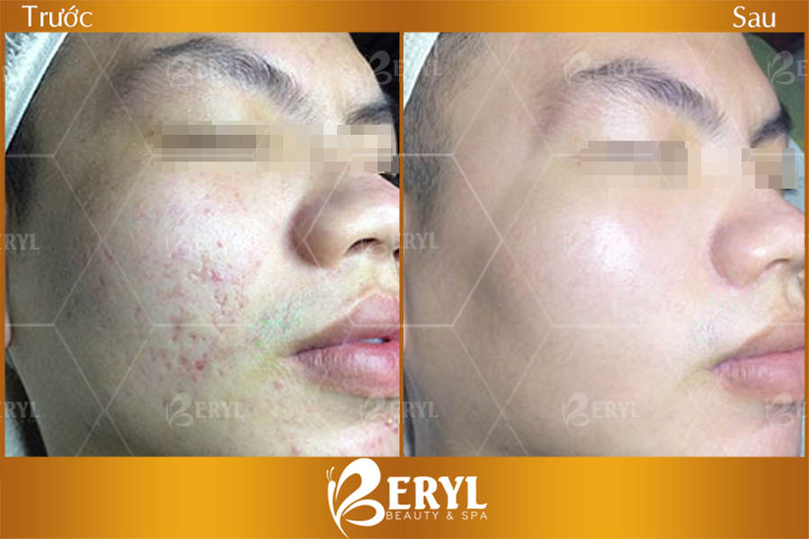 Hình ảnh trước và sau khi lăn kim trị sẹo trên mặt tại Beryl Beauty & Spa