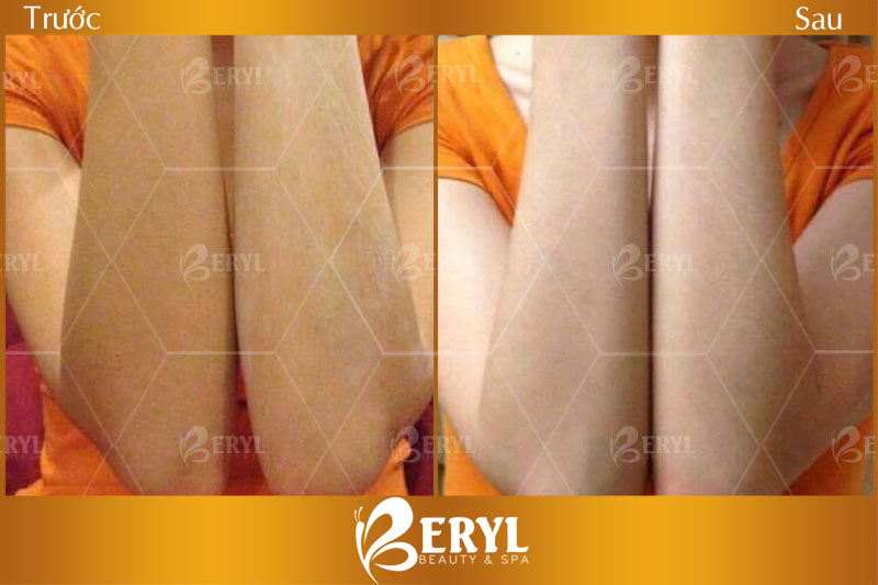 Hình ảnh trước và sau khi tắm trắng tại Beryl Beauty & Spa  quận Bình Thạnh TPHCM