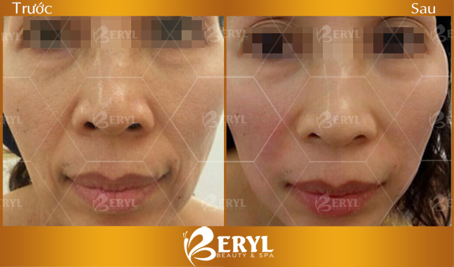 Hình ảnh trước và sau khi nâng cơ mặt tại Beryl Beauty & Spa