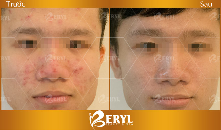 Hình ảnh trước và sau khi điều trị mụn cho nam giới tại Beryl Beauty & Spa TPHCM