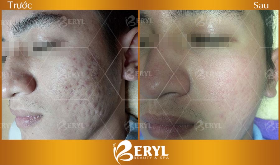 Hình ảnh trước và sau khi điều trị mụn thâm hiệu quả tại Beryl Beauty & Spa TPHCM