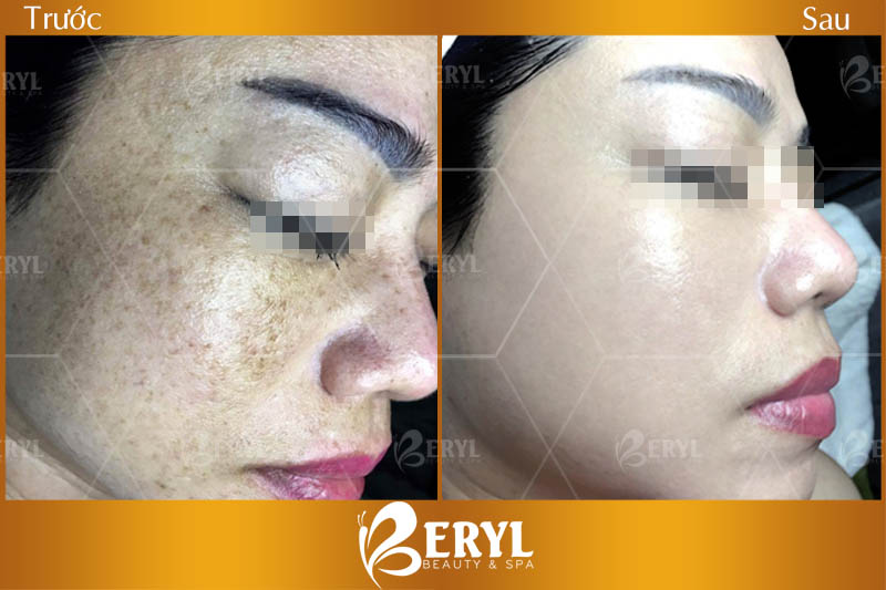 Hình ảnh trước và sau khi trị nám da mặt hiệu quả tại Beryl Beauty & Spa quận Bình Thạnh