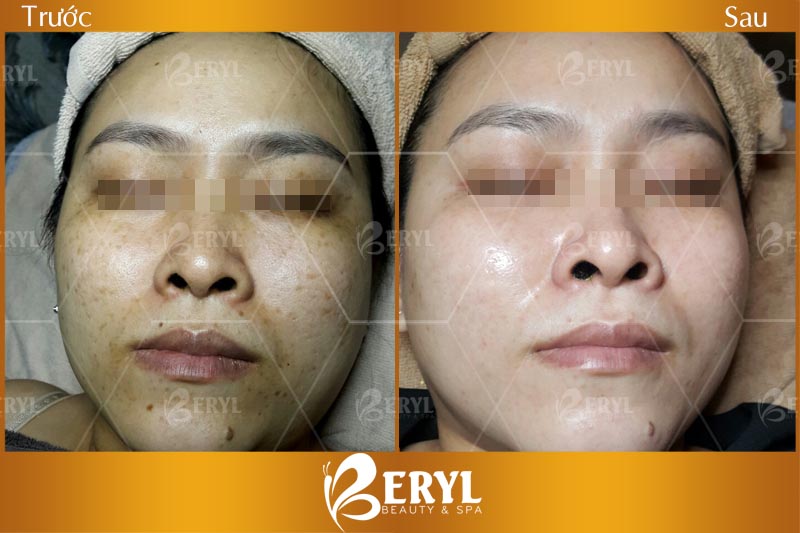 Hình ảnh sau khi trị nám da mặt hiệu quả tại Beryl Beauty & Spa TPHCM