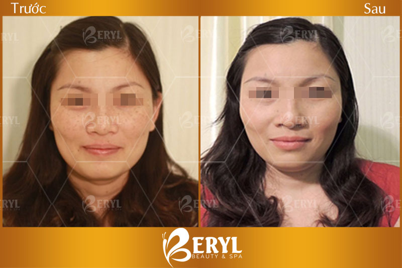 Hình ảnh trước và sau điều trị tàn nhang tại Beryl Beauty & Spa
