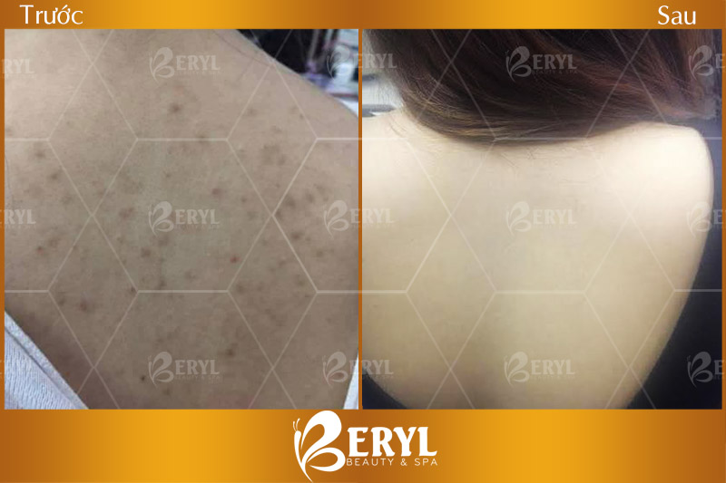 Hình ảnh điều trị thâm lưng bằng công nghệ Tảo Silic tại Beryl Beauty & Spa