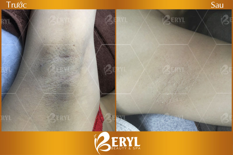 Tham khảo hình ảnh trước và sau khi trị thâm nách tại Beryl Beauty & Spa