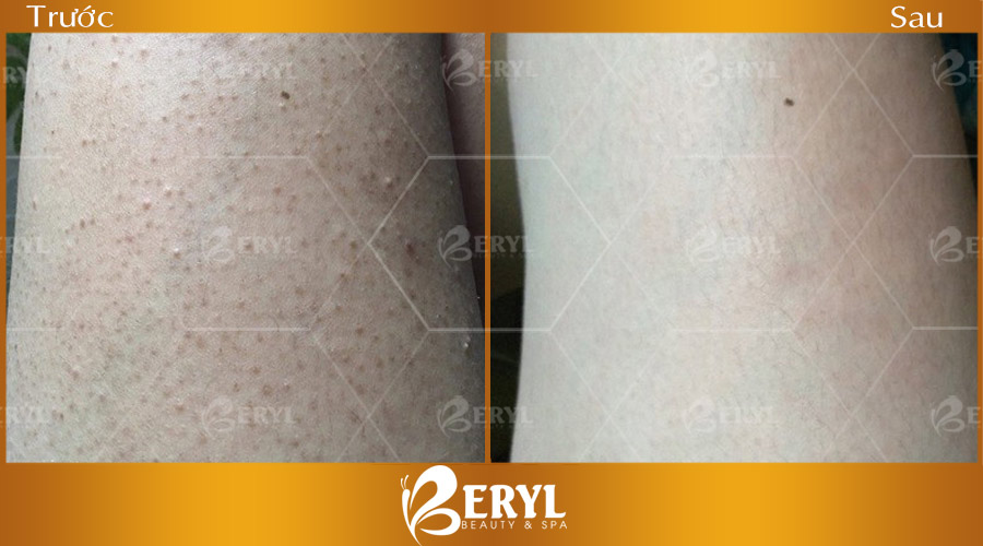 Hình trước và sau khi trị viêm nang lông tại nhà bằng Cao thuốc bắc.