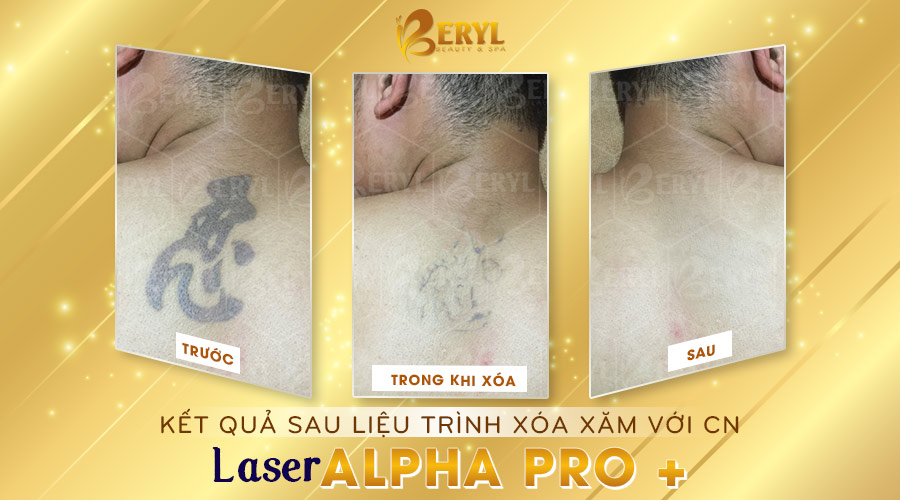 Hình ảnh trước và sau khi xóa hình xăm trên lưng bằng Laser Alpha Pro+ tại Beryl Beauty. 